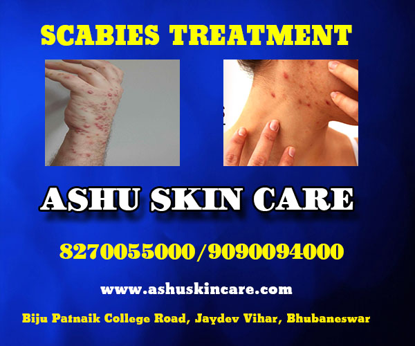 best scabies treatment clinic in bhubaneswar near apollo hospital